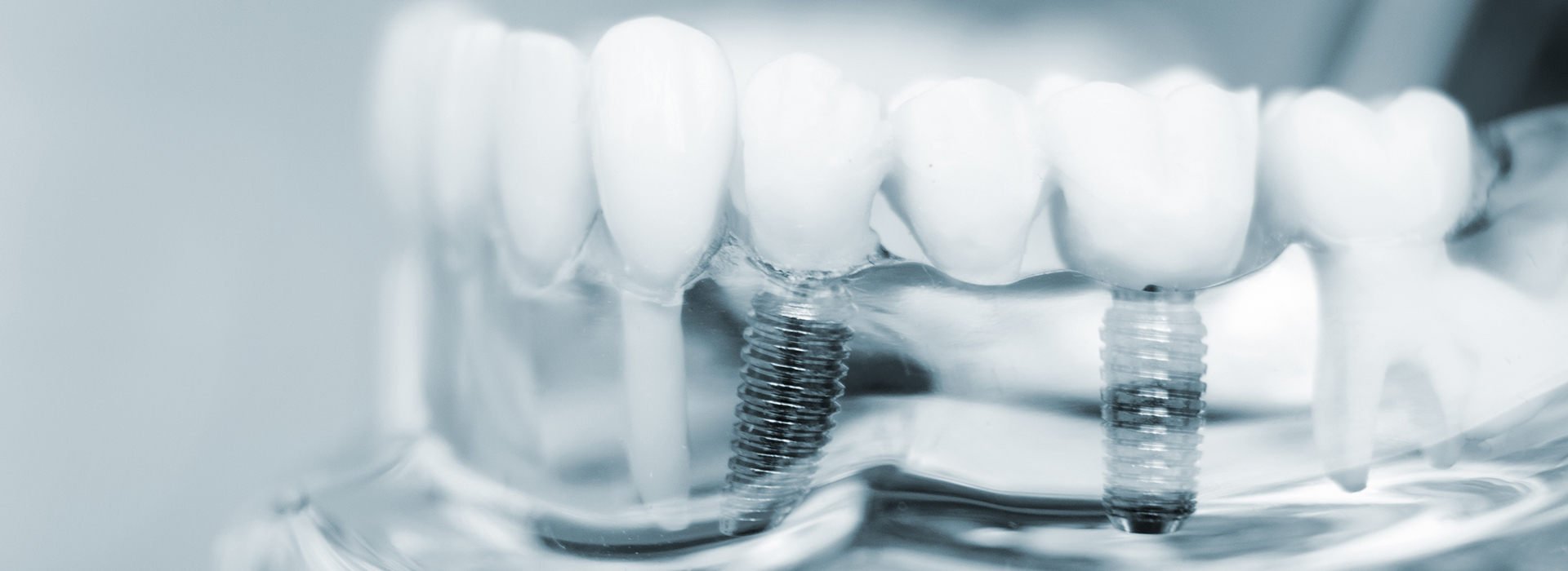 The image displays a close-up view of a dental implant with screws and a transparent plastic cover, showcasing the implant s components.