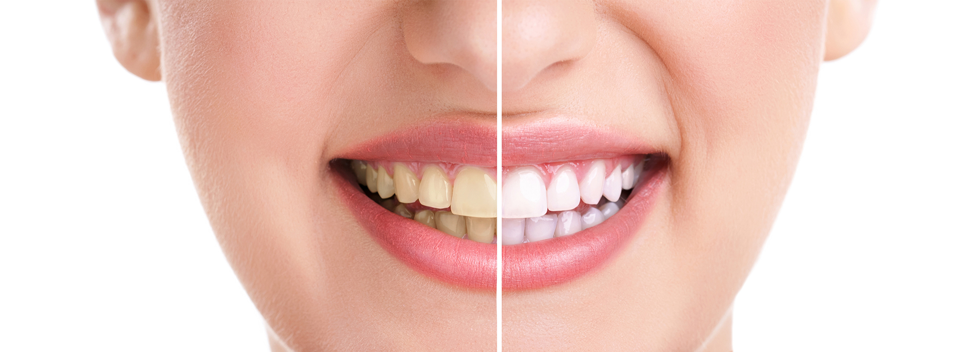 The image shows a close-up of a person s face with a focus on their teeth, highlighting the results of dental work.